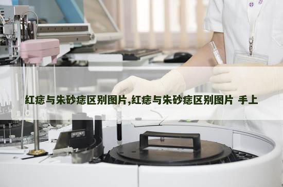 红痣与朱砂痣区别图片,红痣与朱砂痣区别图片 手上